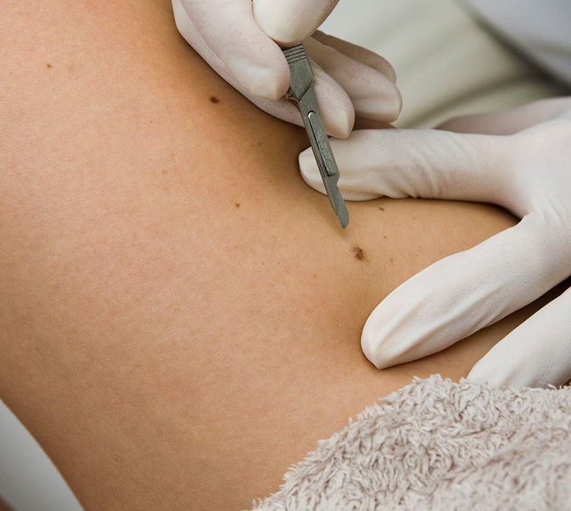 Non-cancerous Skin Diseases Therapeutics Market Analysis, Size, and Forecast 2026-2030: North America (US, Canada, and Mexico), Europe (Germany, UK, and France), APAC (China, India, and Japan), South America (Brazil, Argentina, and Colombia), Middle East and Africa (Saudi Arabia, UAE, and Turkey), Asia, Rest of World (ROW)