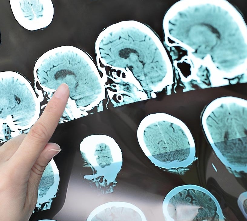 Acute Ischemic Stroke Therapeutics Market Analysis, Size, and Forecast 2026-2030: North America (US, Canada, and Mexico), Europe (Germany, UK, and France), APAC (China, Japan, and India), South America (Brazil, Argentina, and Colombia), Middle East and Africa (South Africa, UAE, and Saudi Arabia), Asia, Rest of World (ROW)