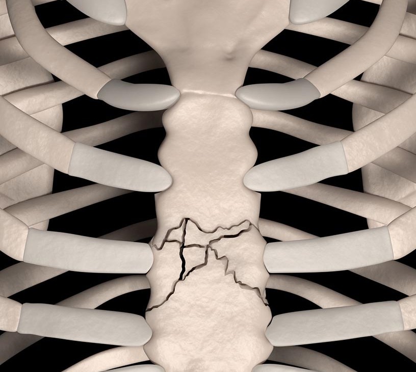 Sternal Closure Systems Market Analysis, Size, and Forecast 2026-2030: North America (US, Canada, and Mexico), Europe (Germany, UK, and France), APAC (China, India, and Japan), South America (Brazil, Argentina, and Colombia), Middle East and Africa (Saudi Arabia, Turkey, and UAE), Asia, Rest of World (ROW)