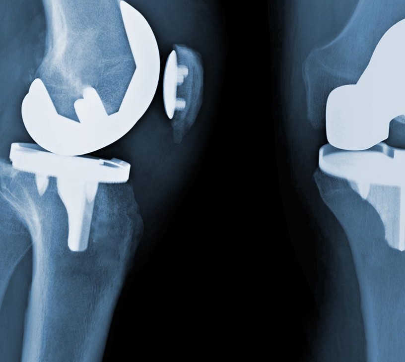 Digit Joint Implants Market Analysis, Size, and Forecast 2026-2030: North America (US, Canada, and Mexico), Europe (Germany, France, and UK), APAC (China, Japan, and India), South America (Brazil and Argentina), Middle East and Africa (Saudi Arabia, UAE, and Turkey), Asia, Rest of World (ROW)
