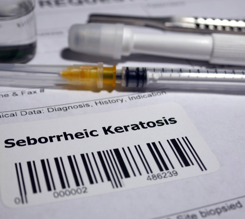 Seborrheic Keratosis Treatment Market Analysis, Size, and Forecast 2025-2029: North America (US, Canada, and Mexico), Europe (Germany, UK, and France), APAC (China, India, and Japan), South America (Brazil, Argentina, and Colombia), Middle East and Africa (Saudi Arabia, UAE, and Turkey), Asia, Rest of World (ROW)