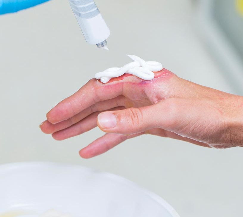 Burn Care Market Analysis, Size, and Forecast 2026-2030: North America (US, Canada, and Mexico), Europe (Germany, UK, and France), APAC (China, Japan, and India), Middle East and Africa (UAE, South Africa, and Saudi Arabia), South America (Brazil), Asia, Rest of World (ROW)