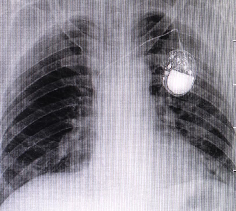 Cardiac Pacemakers Market Analysis, Size, and Forecast 2026-2030: North America (US, Canada, and Mexico), Europe (Germany, France, and UK), APAC (China, Japan, and India), South America (Brazil, Argentina, and Colombia), Middle East and Africa (Saudi Arabia, UAE, and South Africa), Asia, Rest of World (ROW)