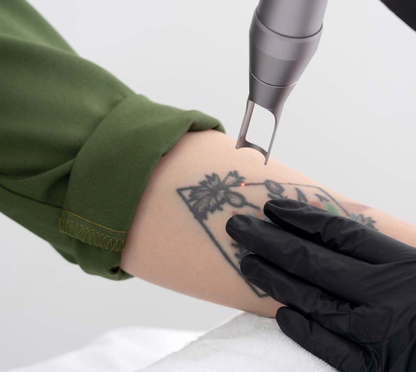 Tattoo Removal Market Analysis, Size, and Forecast 2026-2030: North America (US, Canada, and Mexico), Europe (Germany, UK, and France), APAC (China, Japan, and India), South America (Brazil and Argentina), Middle East and Africa (Saudi Arabia, UAE, and South Africa), and Rest of World (ROW)