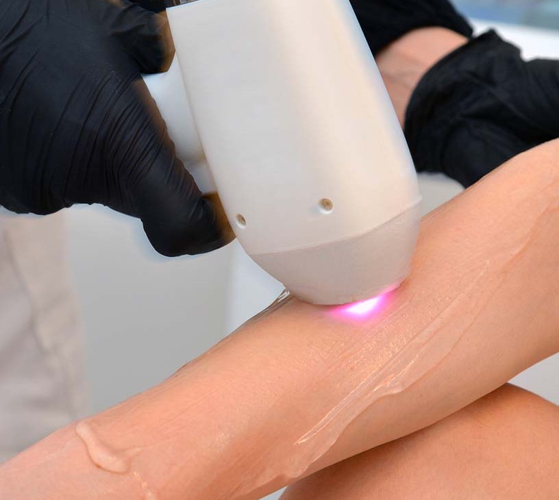 Aesthetic Lasers Market Analysis, Size, and Forecast 2026-2030: North America (US, Canada, and Mexico), Europe (Germany, UK, and France), APAC (China, Japan, and India), South America (Brazil, Argentina, and Colombia), Middle East and Africa (Saudi Arabia, UAE, and South Africa), Asia, Rest of World (ROW)