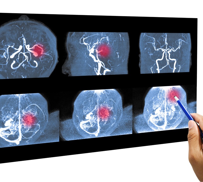 Magnetic Resonance Angiography Market Analysis, Size, and Forecast 2025-2029: North America (US, Canada, and Mexico), Europe (Germany, UK, and France), APAC (China, India, and Japan), South America (Brazil), Middle East and Africa (South Africa, UAE, and Saudi Arabia), Asia, Rest of World (ROW)