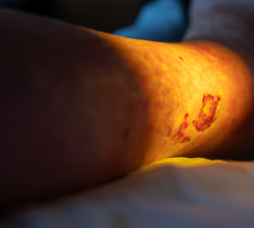 Diabetic Foot Ulcer Treatment Market Analysis, Size, and Forecast 2026-2030: North America (US, Canada, and Mexico), Europe (Germany, France, and UK), APAC (China, India, and Japan), Middle East and Africa (UAE, South Africa, and Saudi Arabia), South America (Brazil), Asia, Rest of World (ROW)