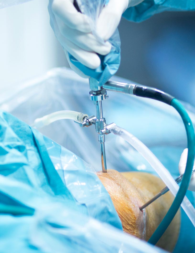 Top Drivers for Arthroscopy Devices Market Size to Grow by $ 1.78 bn During 2021-2025