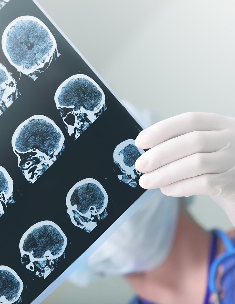 Cranial Implants Market Growth Analysis | Trends, Drivers and Vendor Forecasts for 2021-2025