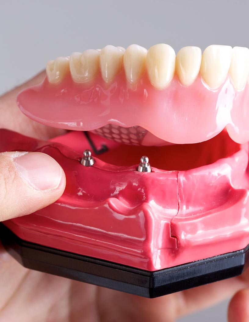 Global dentures market 2024-2028