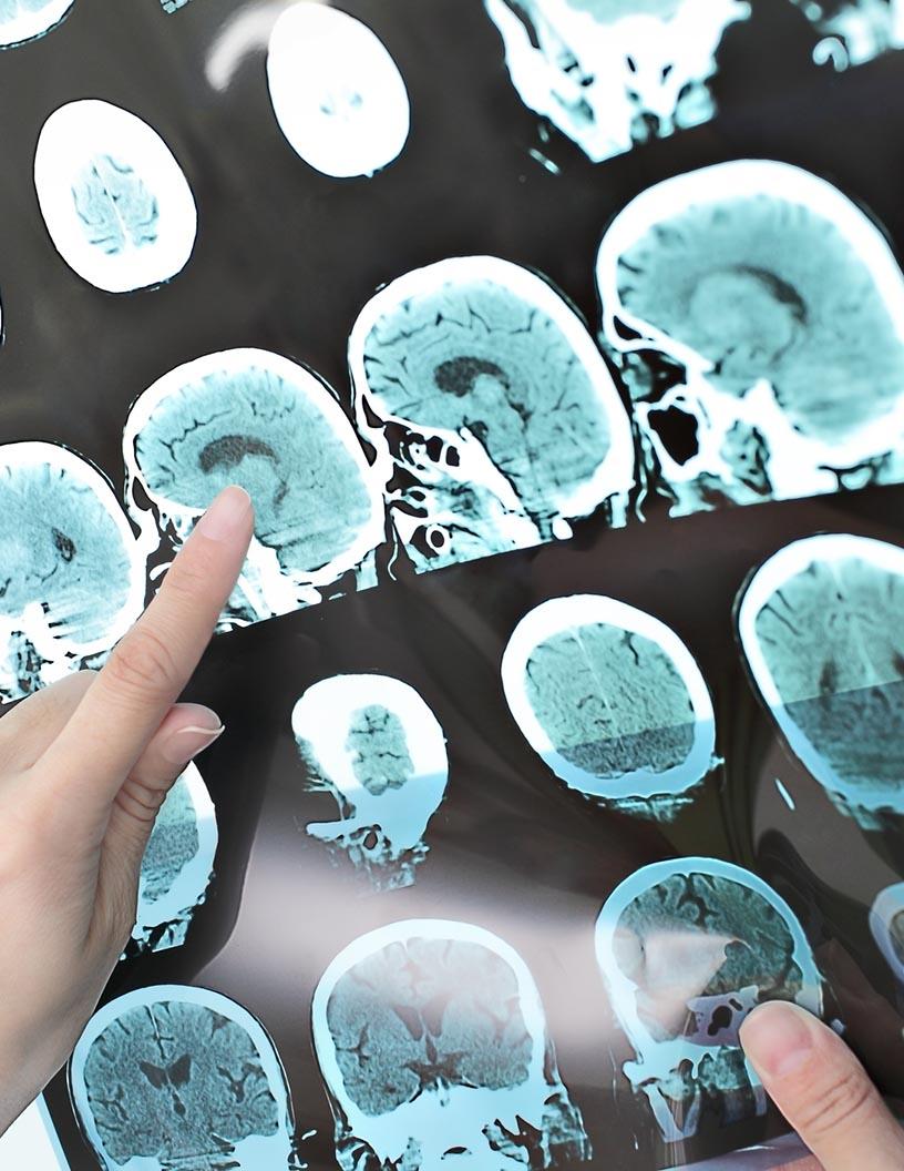 Global Acute Ischemic Stroke Therapeutics Market 2024-2028