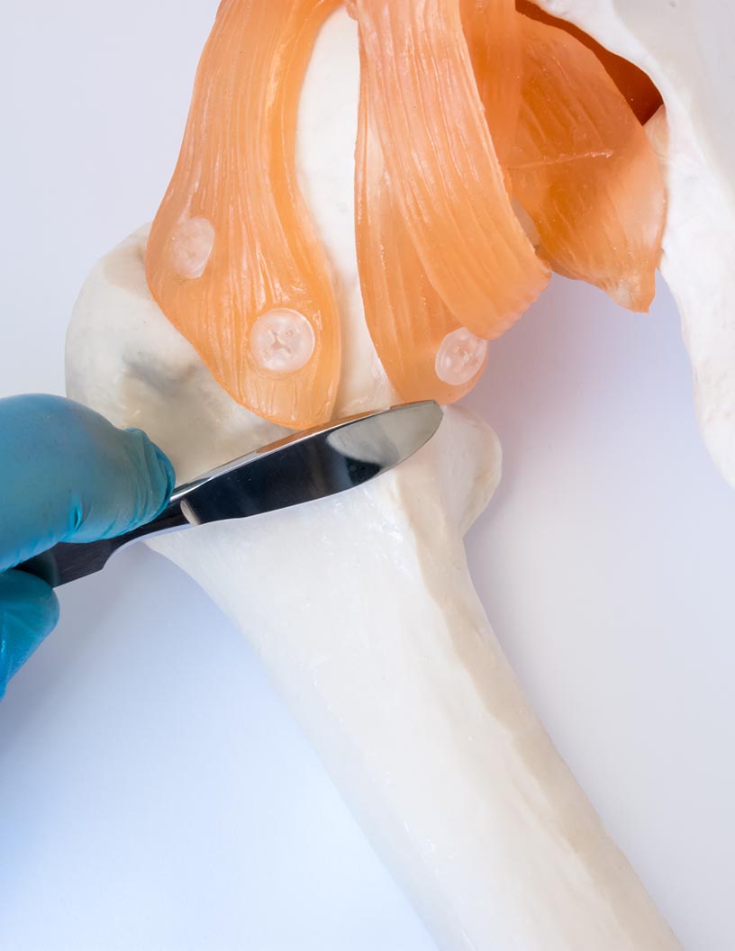 Global Ankle Replacement (Arthroplasty) Market 2021-2025 | Johnson and Johnson Inc., MatOrtho Ltd., Smith and Nephew plc, Stryker Corp. are among the key vendors discussed