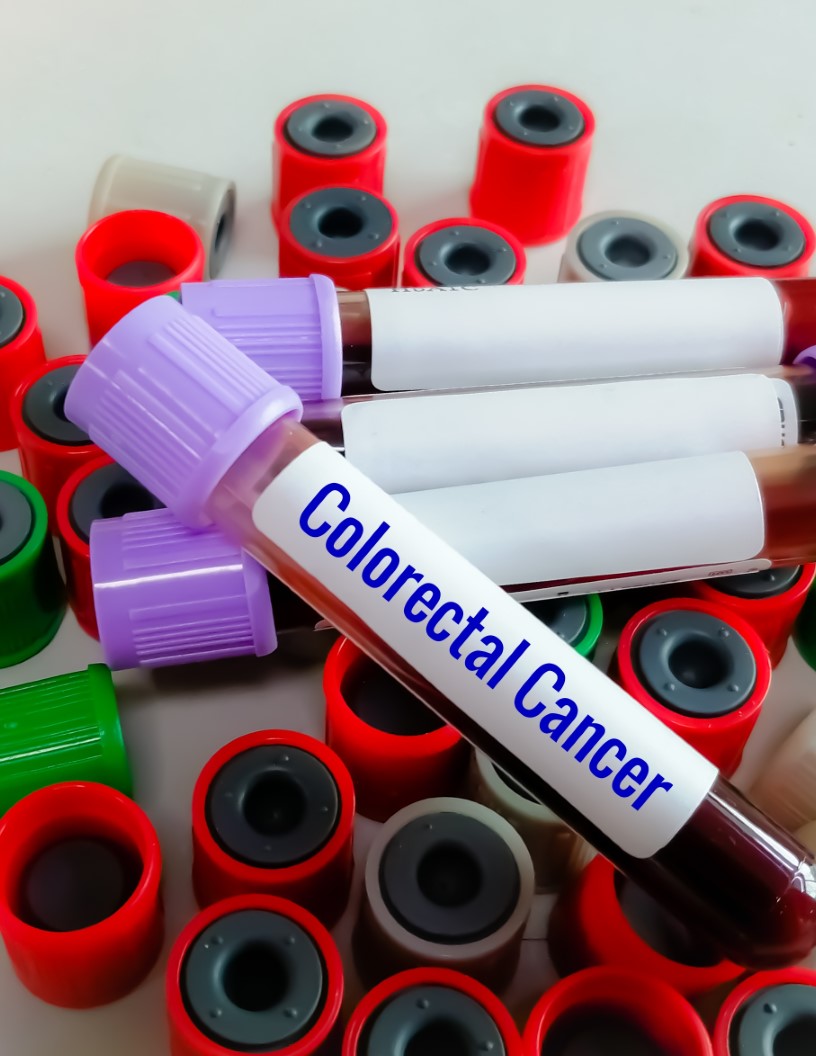 Global colorectal cancer therapeutics market 2024-2028