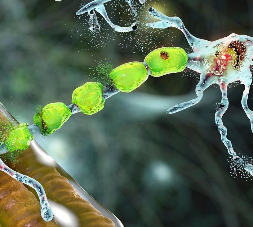 Global Amyotrophic Lateral Sclerosis Treatment Market 2025-2029