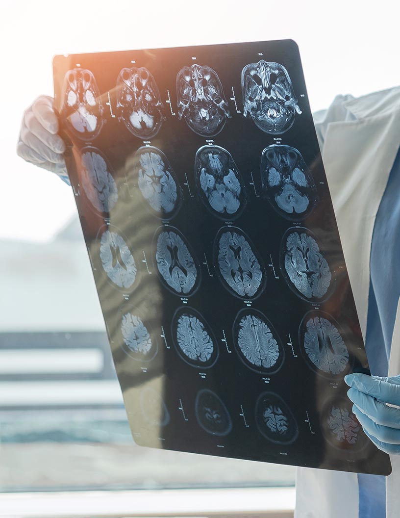 Global neurologic disorders therapeutics market 2024-2028
