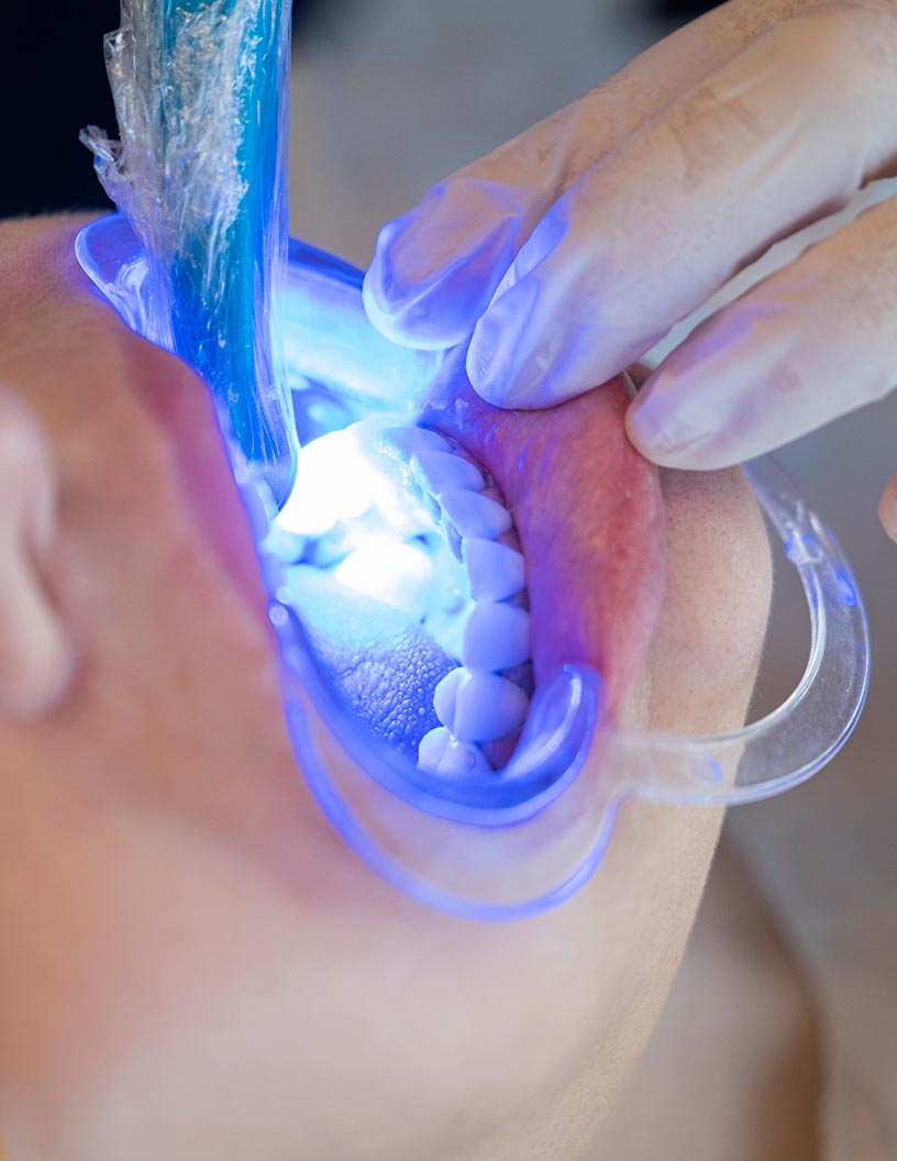 Global dental curing lights market 2024-2028