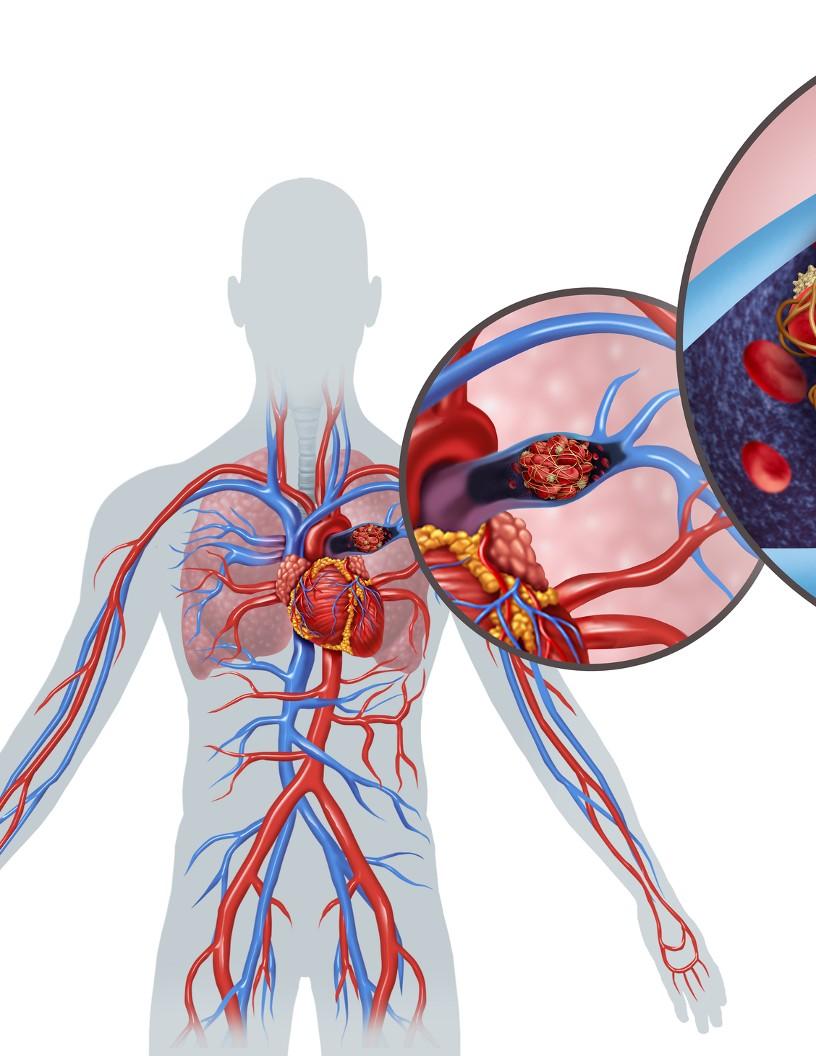 Global Pulmonary Embolism Therapeutics Market 2025-2029