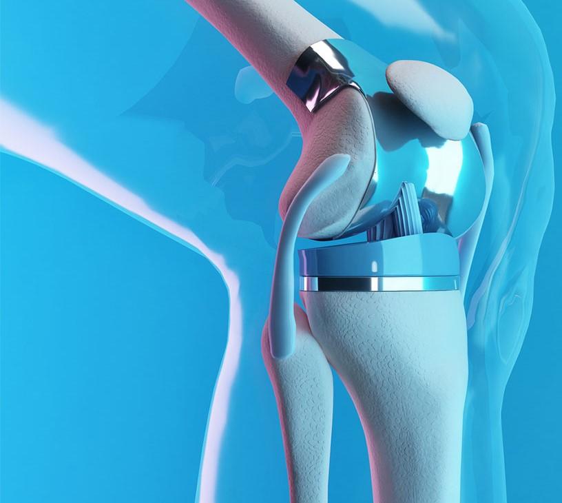 Global Artificial Bone Market 2025-2029