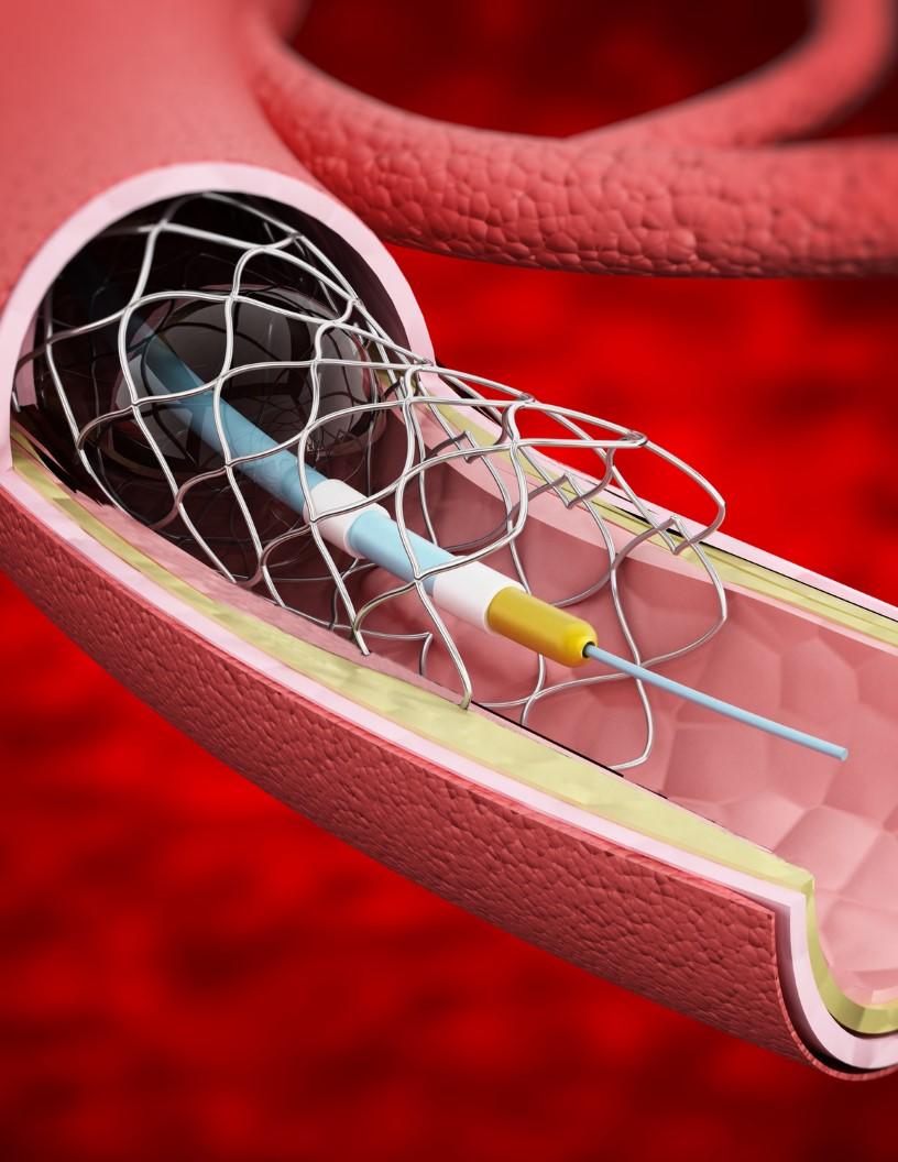 Global Interventional Radiology Products Market 2024-2028