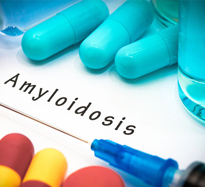 Amyloidosis Therapeutics Market by Type and Geography - Global Forecast and Analysis 2019-2023