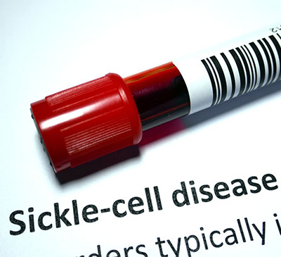 Gene Therapy for Sickle-Cell Diseases - A Pipeline Analysis Report
