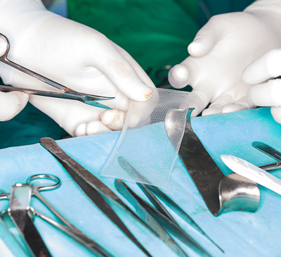 Hernia Repair Devices Market by Product and Geography - Forecast and Analysis 2021-2025