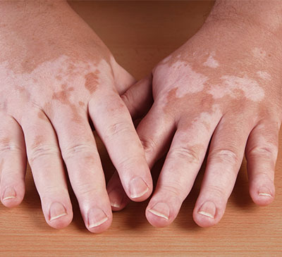 Global Pigmentation Disorder Therapeutics Market 2018-2022