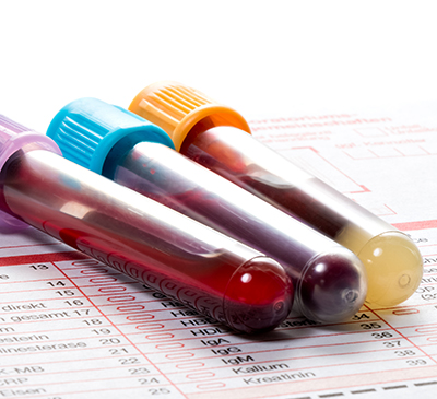 Global Hemoglobinopathies Treatment Market 2019-2023