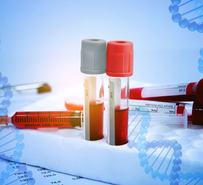 Hemophilia Gene Therapy - A Pipeline Analysis Report