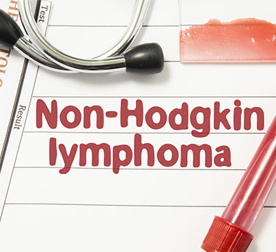 Global Hodgkins Lymphoma Drugs Market 2019-2023