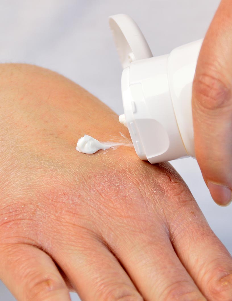 Eczema Therapeutics Market Analysis North America, Europe, Asia, Rest of World (ROW) - US, Canada, Germany, UK, China - Size and Forecast 2024-2028