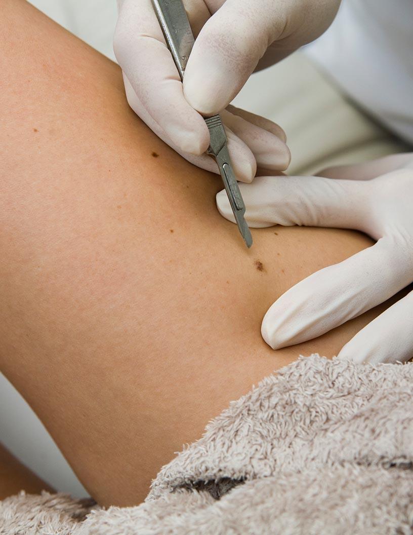 Non-Cancerous Skin Diseases Therapeutics Market Analysis North America, Europe, Asia, Rest of World (ROW) - US, Germany, France, Canada, Japan, India, UK, China, South Korea, South Africa - Size and Forecast 2025-2029