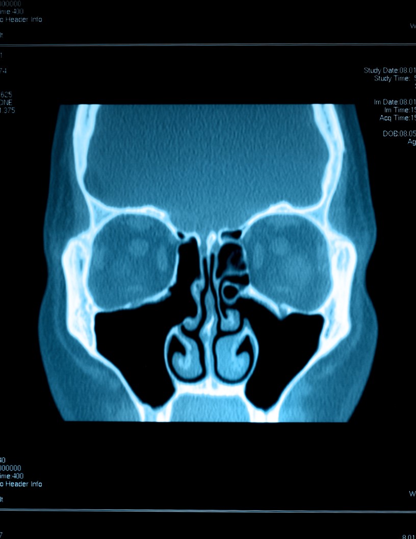 Sinus Dilation Devices Market Analysis North America, Europe, Asia, Rest of World (ROW) - US, Germany, Japan, Canada, UK - Size and Forecast 2024-2028