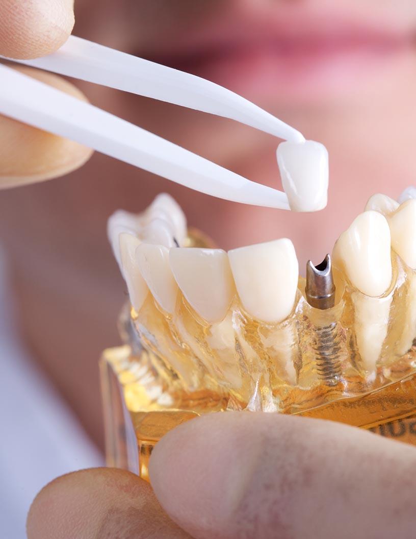 Dental Implants Market Analysis, Size, and Forecast 2025-2029: North America (US, Canada, and Mexico), Europe (France, Germany, Italy, and UK), APAC (China, India, and Japan), and Rest of World (ROW)