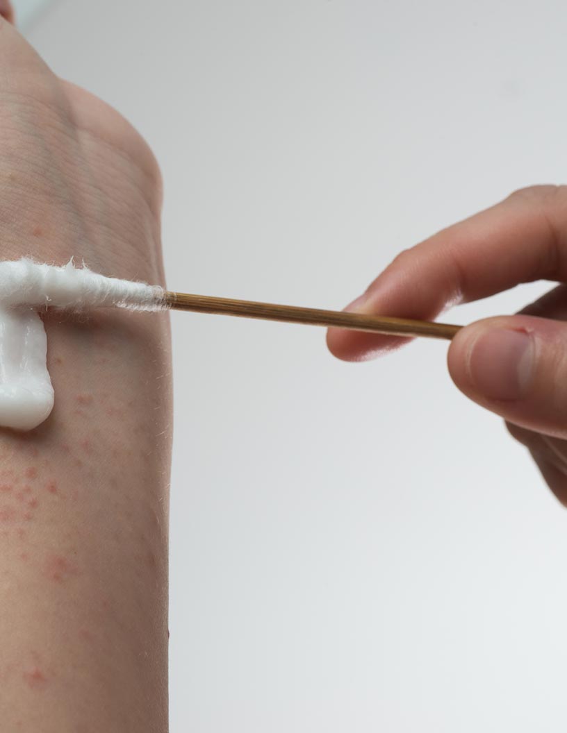 Pruritus Therapeutic Market by Disease Type and Geography - Forecast and Analysis 2021-2025