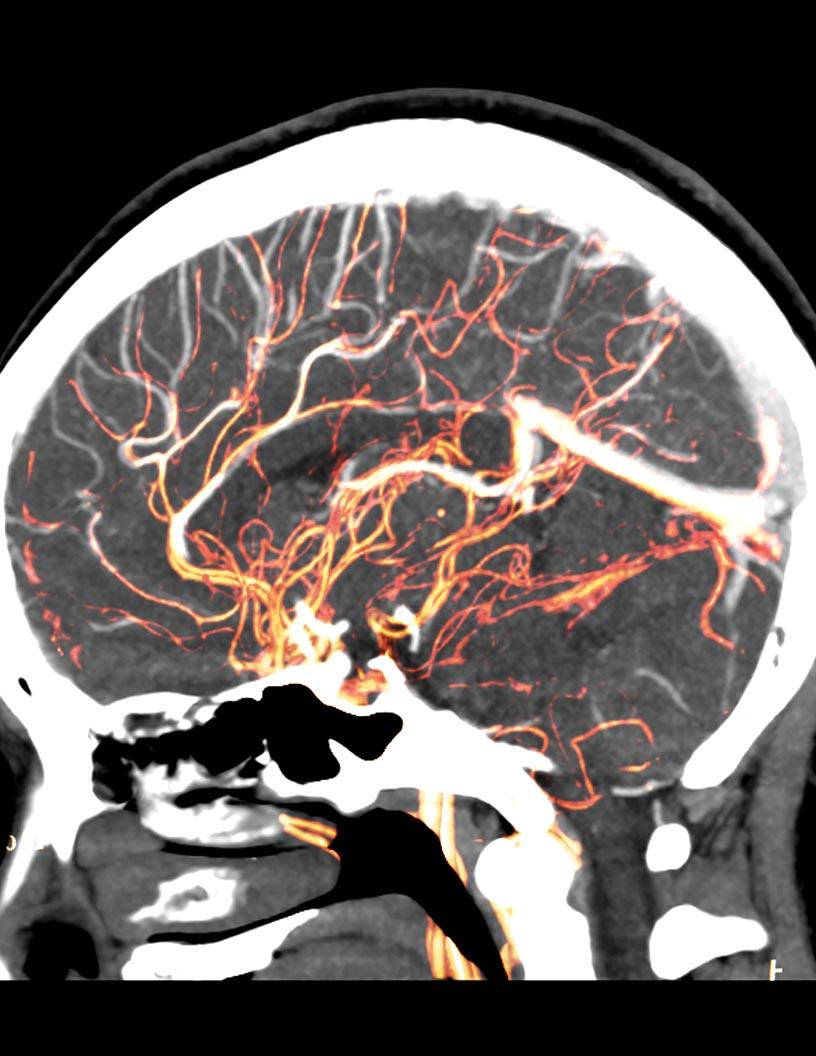 Flow Diversion Aneurysm Treatment Market Analysis, Size, and Forecast 2025-2029: North America (US, Canada, and Mexico), Europe (France, Germany, Italy, and UK), APAC (China, India, and Japan), and Rest of World (ROW)
