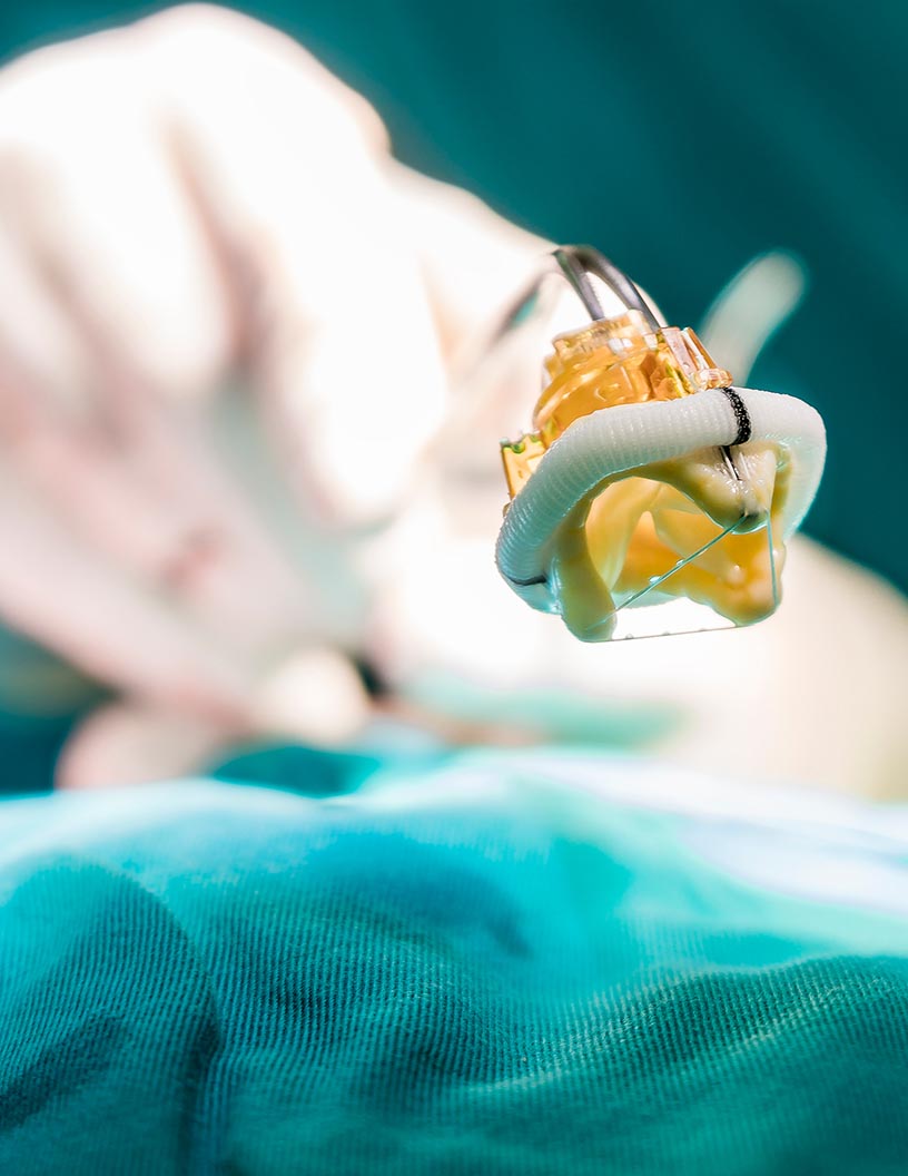 Prosthetic Heart Valves Market Analysis North America, Europe, Asia, Rest of World (ROW) - US, Germany, UK, China, Canada - Size and Forecast 2024-2028