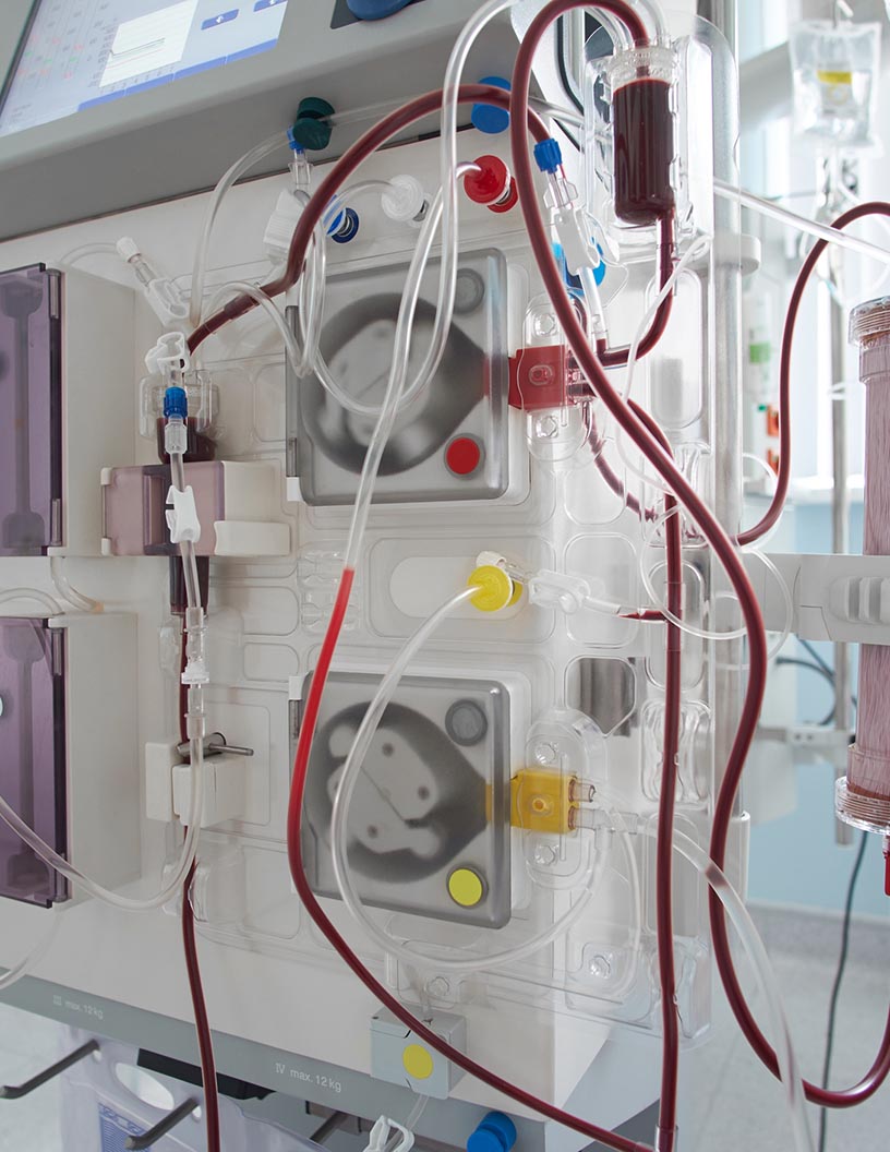 Hemodialysis Catheters Market by Product and Geography - Forecast and Analysis 2021-2025