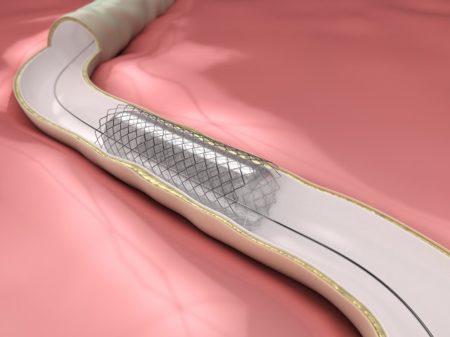 Peripheral Vascular Stents Market by Product, End-user, and Geography - Forecast and Analysis 2020-2024