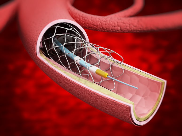 Mechanical Thrombectomy Devices Market by End-user and Geography - Forecast and Analysis 2020-2024