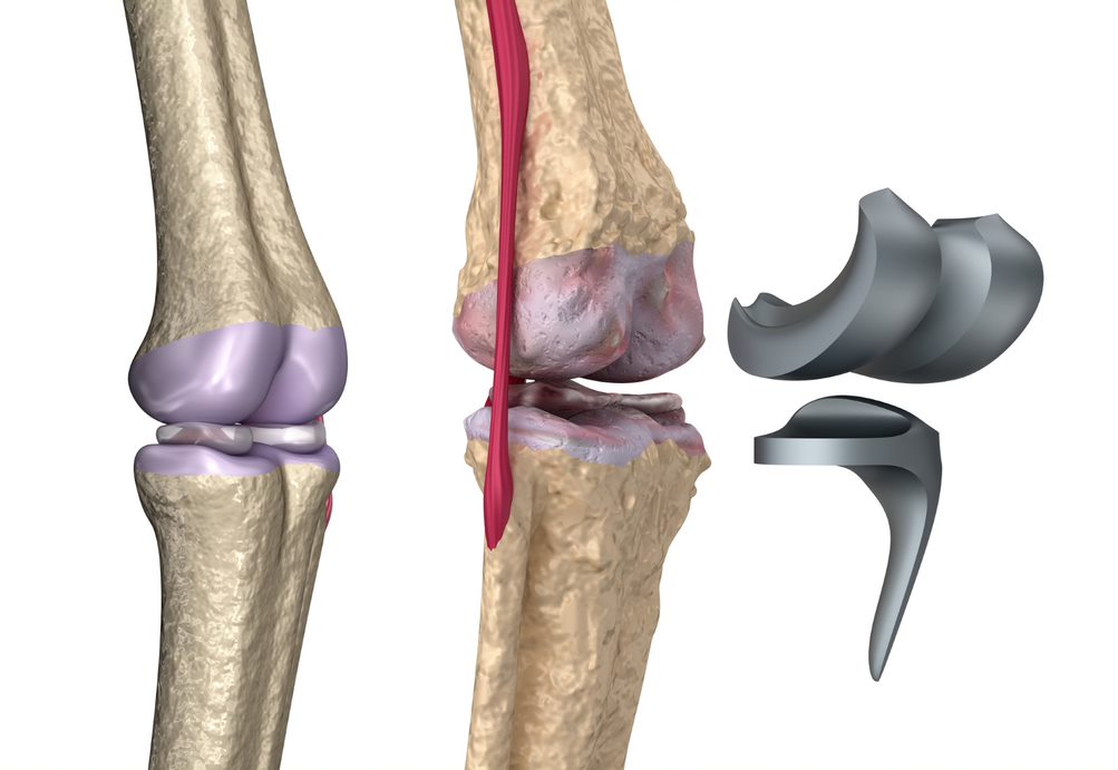 Orthopedic Biomaterials Market by Application and Geography - Forecast and Analysis 2020-2024