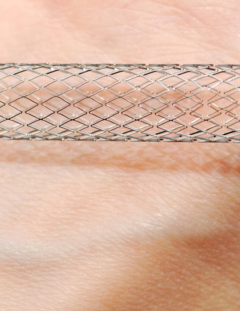 Drug-eluting Stent Market by Type and Geography - Forecast and Analysis 2021-2025