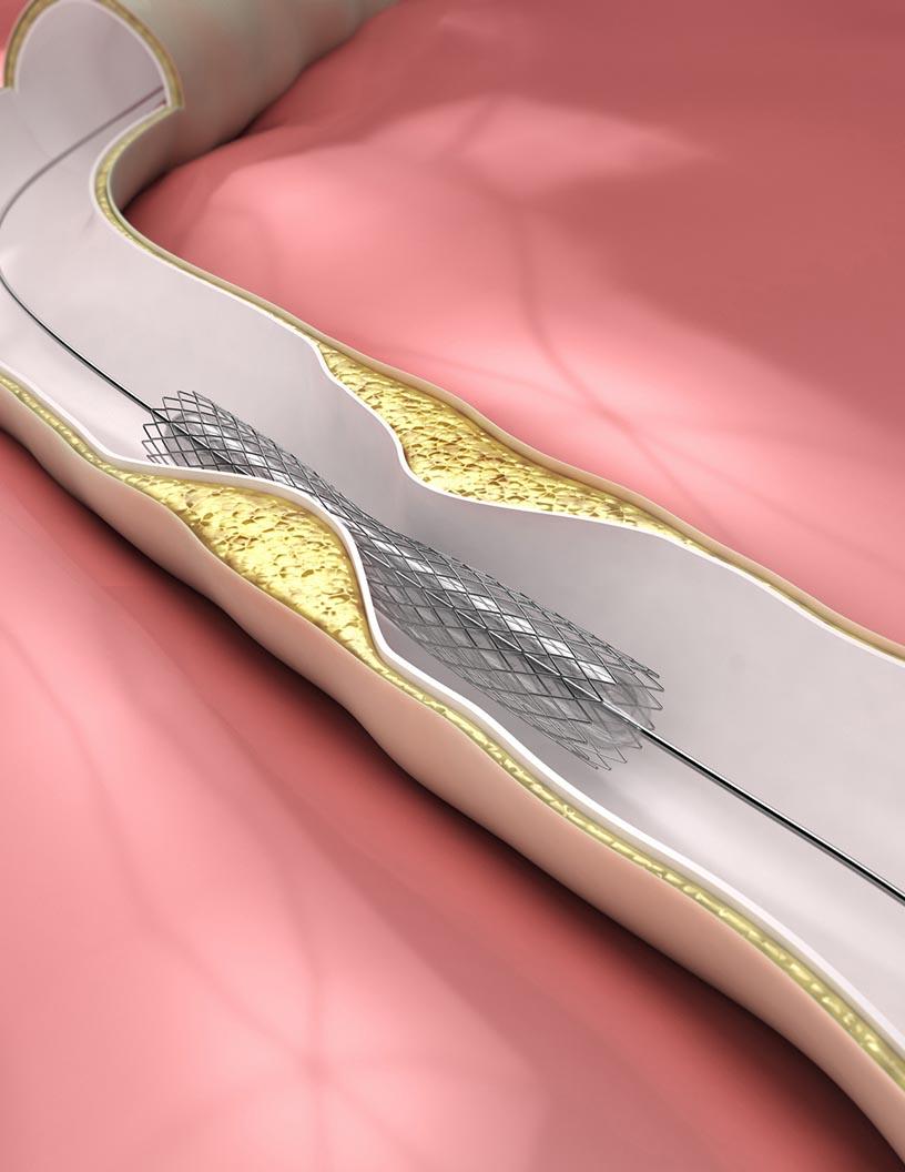Embolic Protection Devices Market Analysis, Size, and Forecast 2025-2029: North America (US and Canada), Europe (France, Germany, and UK), APAC (China, India, Japan, and South Korea), South America (Brazil), and Rest of World (ROW)