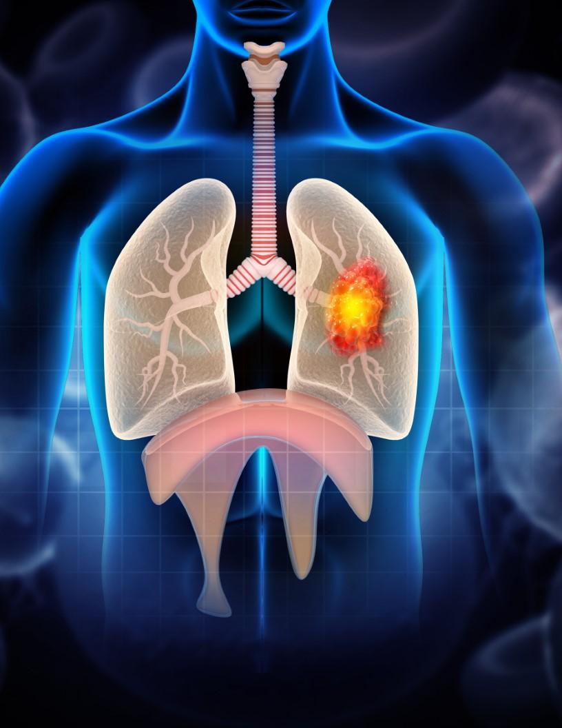 Lung Cancer Therapeutics Market Analysis North America, Europe, Asia, Rest of World (ROW) - US, UK, Canada, China, Japan, France, Germany, India, Spain, South Korea - Size and Forecast 2025-2029