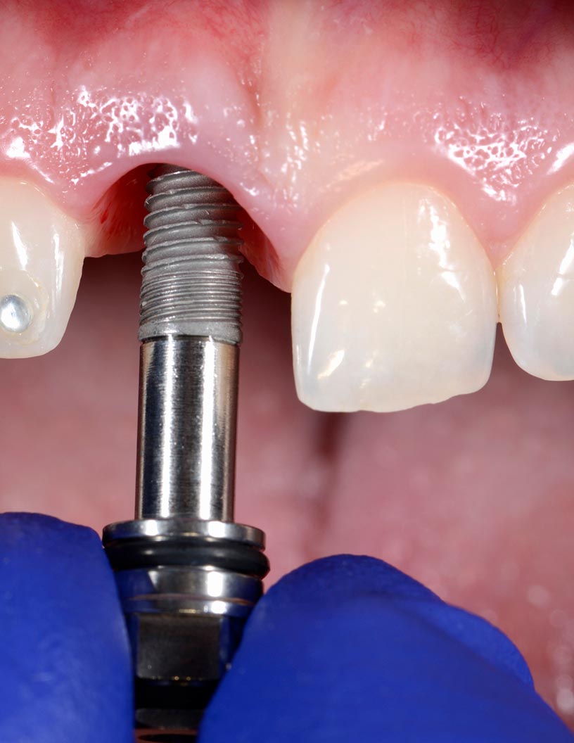 Metal Implants and Medical Alloys Market Analysis North America, APAC, Europe, Middle East and Africa, South America - US, China, Japan, France, UK - Size and Forecast 2024-2028