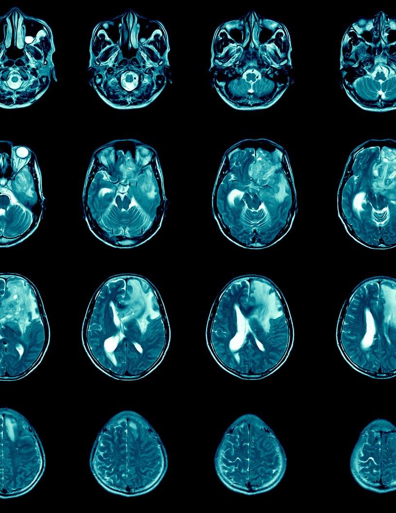 Glioblastoma Multiforme Treatment Market Analysis North America, Europe, Asia, Rest of World (ROW) - US, Germany, Canada, China, UK - Size and Forecast 2024-2028