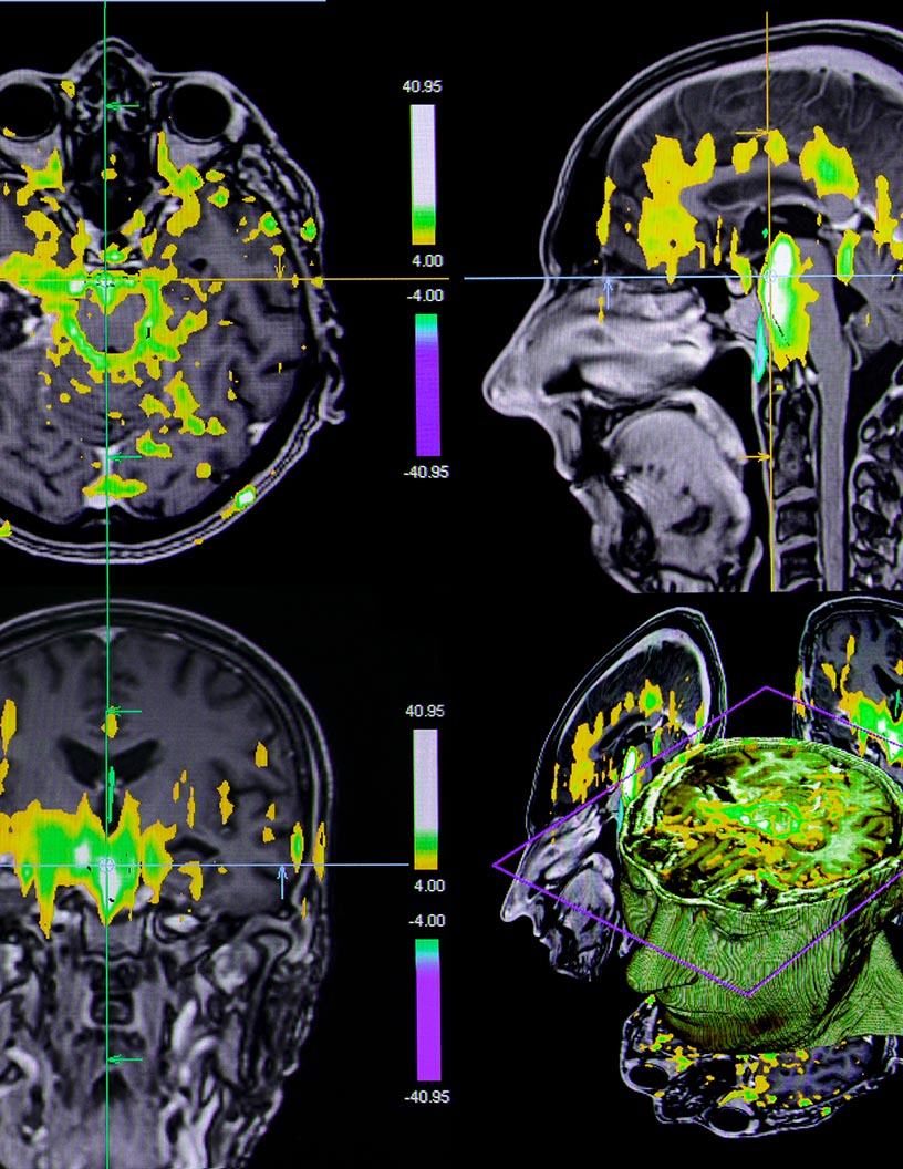 Electroretinograph Market by Product, Application, and Geography - Forecast and Analysis 2021-2025