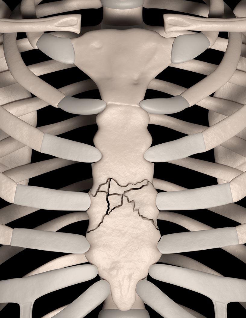 Sternal Closure Systems Market Analysis North America, Europe, Asia, Rest of World (ROW) - US, Germany, UK, China, Japan - Size and Forecast 2024-2028