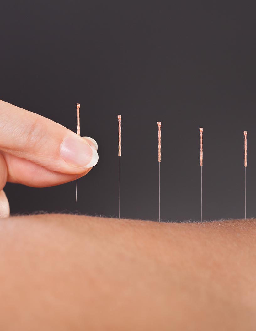 Acupuncture Market Analysis Europe, North America, Asia, Rest of World (ROW) - US, France, Italy, China, Japan - Size and Forecast 2024-2028