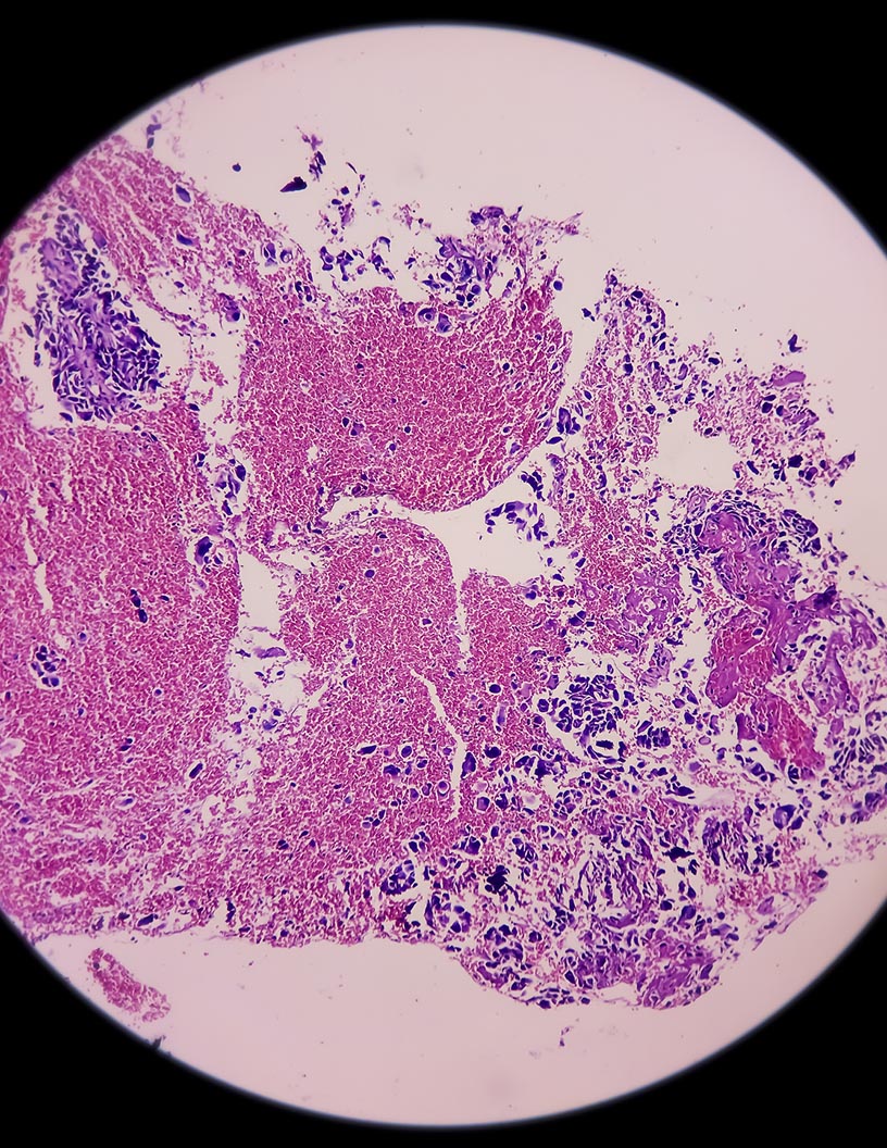 Sarcoma Therapeutics Market Analysis North America, Europe, Asia, Rest of World (ROW) - US, China, Germany, Canada, UK - Size and Forecast 2024-2028